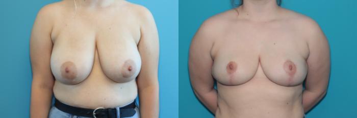 Before & After Breast Reduction Case 337 Front View in West Des Moines & Ames, IA