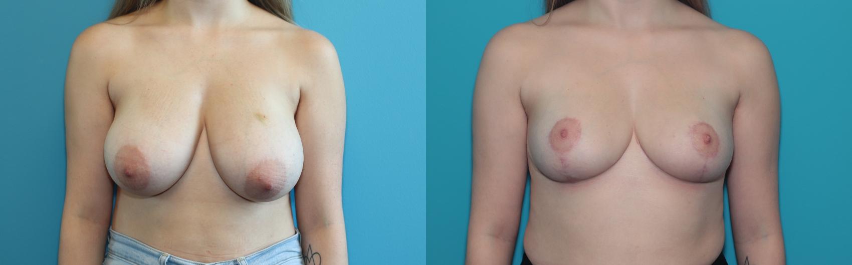 Before & After Breast Reduction Case 343 Front View in West Des Moines & Ames, IA