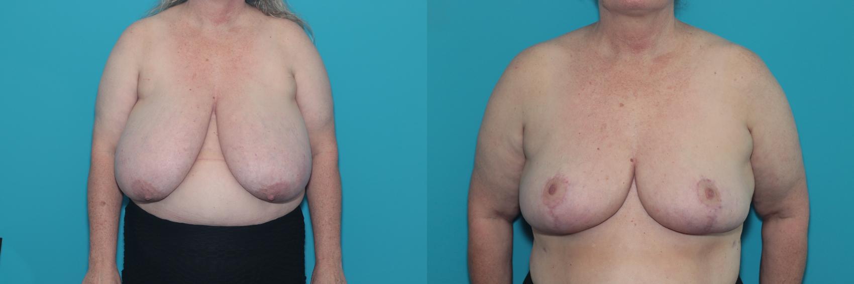 Before & After Breast Reduction Case 362 Front View in West Des Moines & Ames, IA