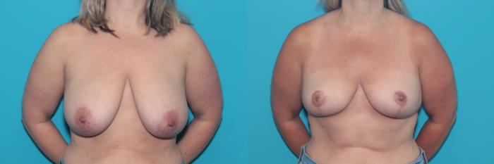 Before & After Breast Lift Case 363 Front View in West Des Moines & Ames, IA