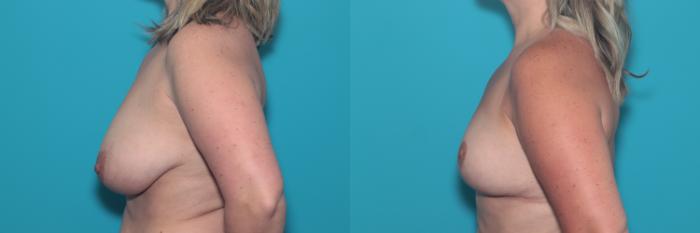 Before & After Breast Lift Case 363 Left Side View in West Des Moines & Ames, IA