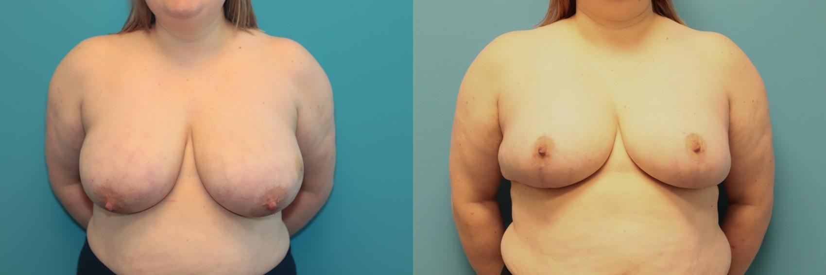 Before & After Breast Reduction Case 368 Front View in West Des Moines & Ames, IA