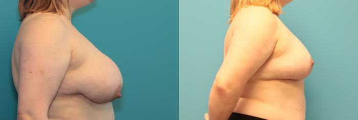 Before & After Breast Reduction Case 368 Right Side View in West Des Moines & Ames, IA