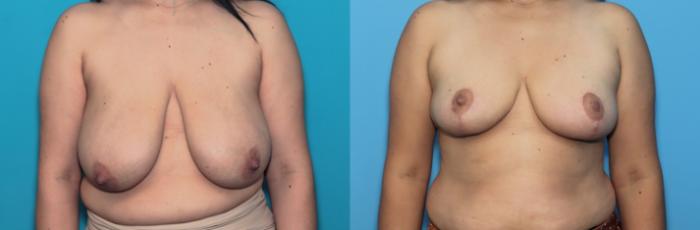 Before & After Breast Reduction Case 371 Front View in West Des Moines & Ames, IA