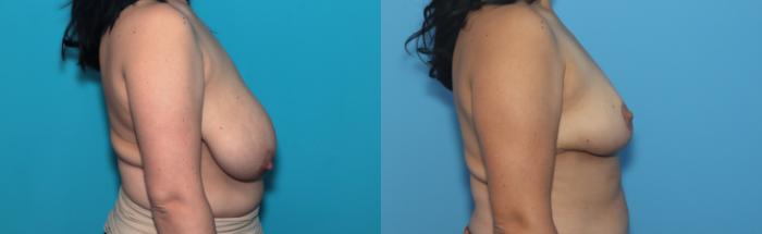 Before & After Breast Reduction Case 371 Right Side View in West Des Moines & Ames, IA