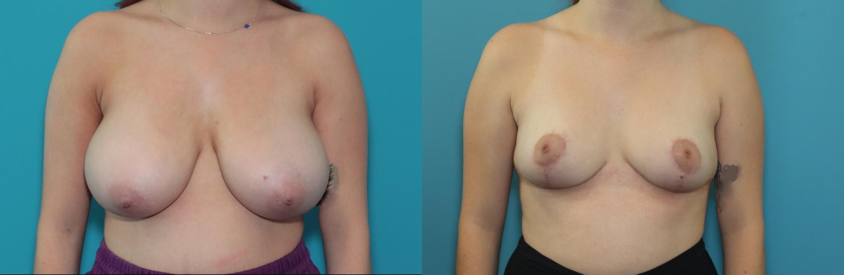 Before & After Breast Reduction Case 376 Front View in West Des Moines, IA