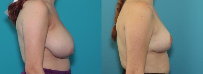 Before & After Breast Reduction Case 376 Right Side View in West Des Moines & Ames, IA