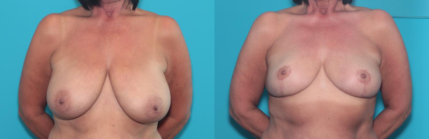 Before & After Breast Reduction Case 393 Front View in West Des Moines & Ames, IA