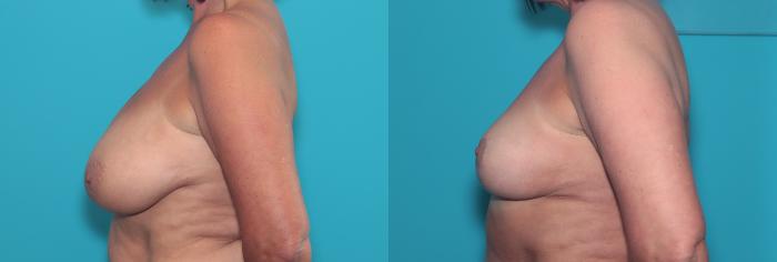 Before & After Breast Lift Case 393 Left Side View in West Des Moines & Ames, IA