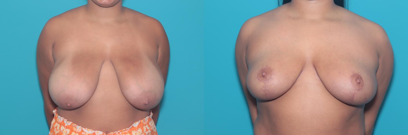 Before & After Breast Reduction Case 412 Front View in West Des Moines & Ames, IA