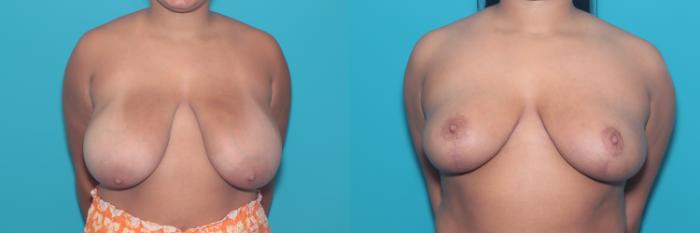 Before & After Breast Reduction Case 412 Front View in West Des Moines & Ames, IA