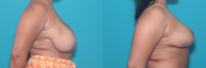 Before & After Breast Reduction Case 412 Right Side View in West Des Moines & Ames, IA