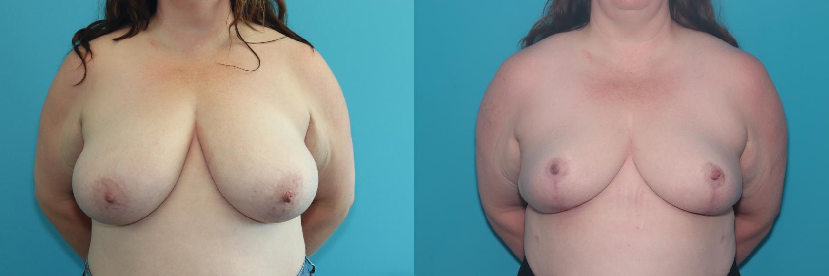 Before & After Breast Reduction Case 432 Front View in West Des Moines & Ames, IA