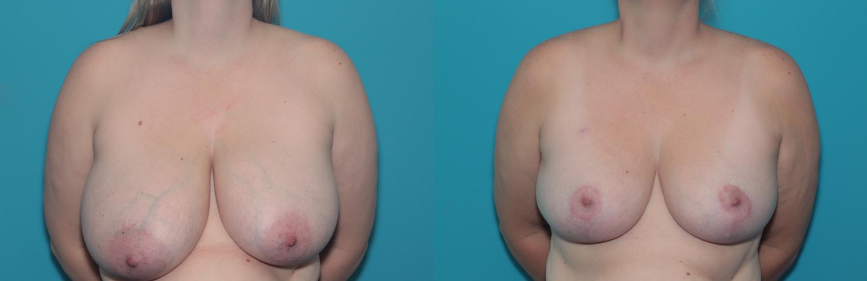 Before & After Breast Reduction Case 483 Front View in West Des Moines & Ames, IA