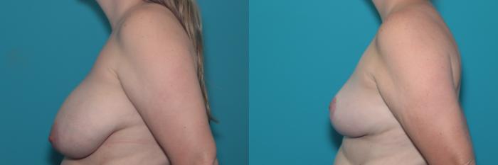 Before & After Breast Reduction Case 483 Left Side View in West Des Moines & Ames, IA