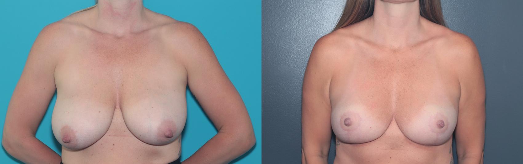 Before & After Breast Reduction Case 484 Front View in West Des Moines & Ames, IA