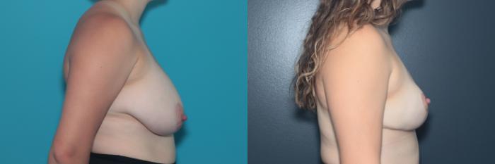 Before & After Breast Reduction Case 485 Right Side View in West Des Moines & Ames, IA