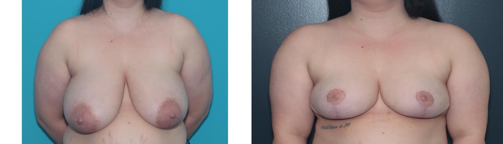 Before & After Breast Reduction Case 488 Front View in West Des Moines & Ames, IA