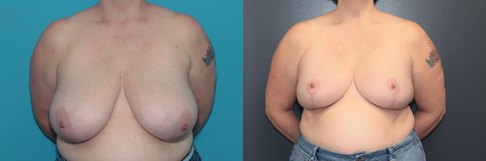 Before & After Breast Reduction Case 499 Front View in West Des Moines & Ames, IA