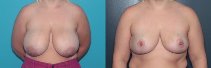 Before & After Breast Reduction Case 500 Front View in West Des Moines & Ames, IA