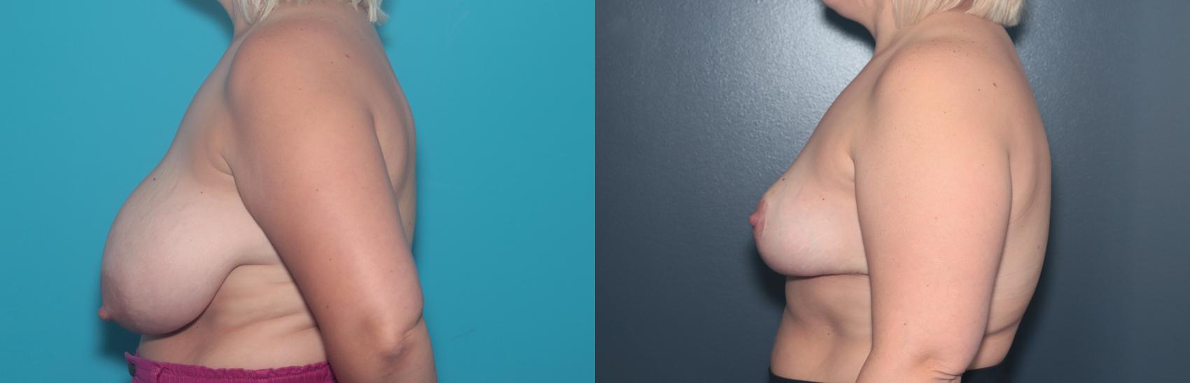 Before & After Breast Reduction Case 500 Left Side View in West Des Moines & Ames, IA