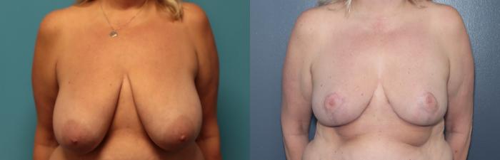 Before & After Breast Reduction Case 542 Front View in West Des Moines & Ames, IA