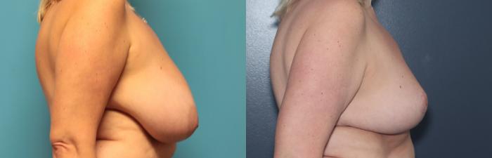 Before & After Breast Reduction Case 542 Left Side View in West Des Moines & Ames, IA