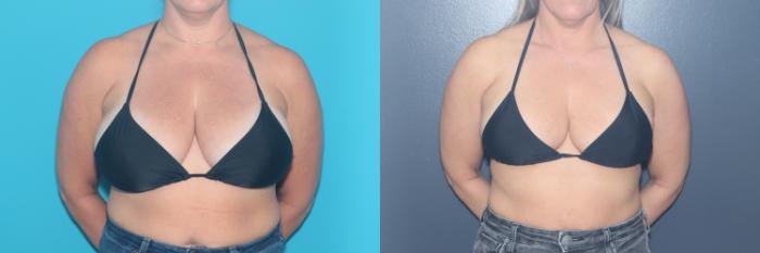 Before & After Breast Reduction Case 550 Bikini Top | Front  View in West Des Moines & Ames, IA
