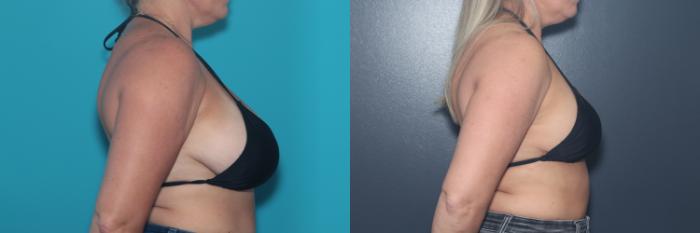 Before & After Breast Reduction Case 550 Bikini Top | Right  View in West Des Moines & Ames, IA