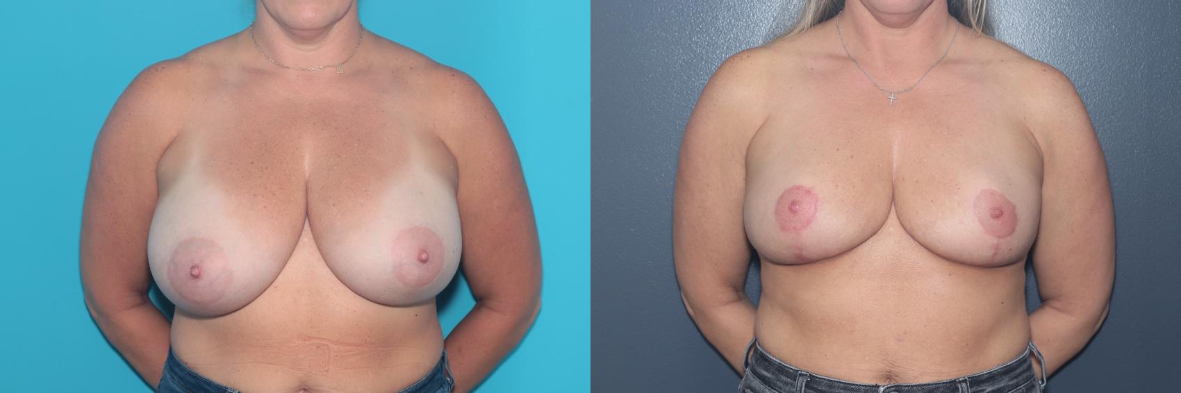 Before & After Breast Reduction Case 550 Front View in West Des Moines & Ames, IA