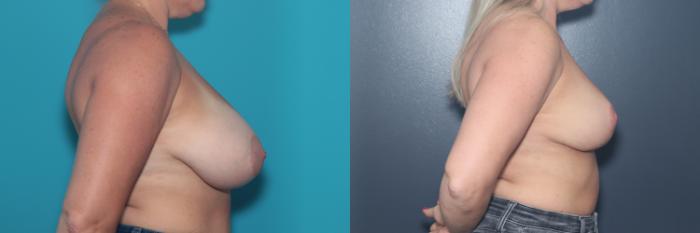 Before & After Breast Reduction Case 550 Right Side View in West Des Moines & Ames, IA