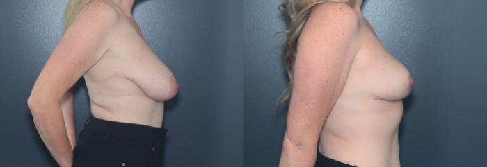 Before & After Breast Lift Case 598 Left Side View in West Des Moines & Ames, IA