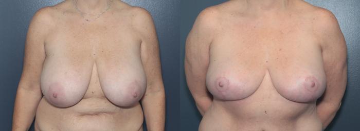 Before & After Breast Reduction Case 624 Front View in West Des Moines & Ames, IA