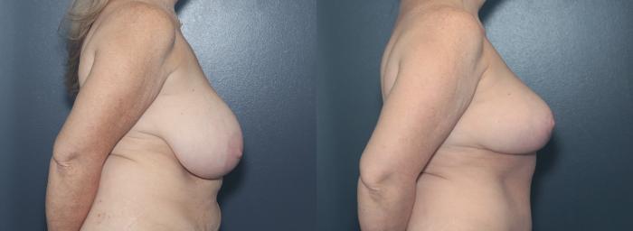 Before & After Breast Reduction Case 624 Left Side View in West Des Moines & Ames, IA