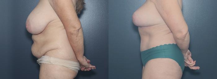 Before & After Breast Reduction Case 624 Right Side View in West Des Moines & Ames, IA