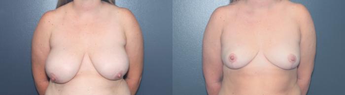 Before & After Breast Reduction Case 631 Front View in West Des Moines & Ames, IA