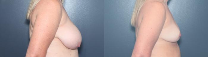 Before & After Breast Reduction Case 631 Left Side View in West Des Moines & Ames, IA