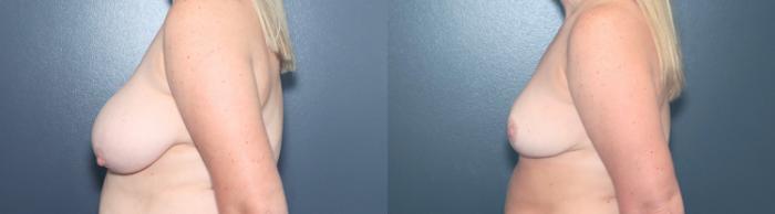 Before & After Breast Reduction Case 631 Right Side View in West Des Moines & Ames, IA
