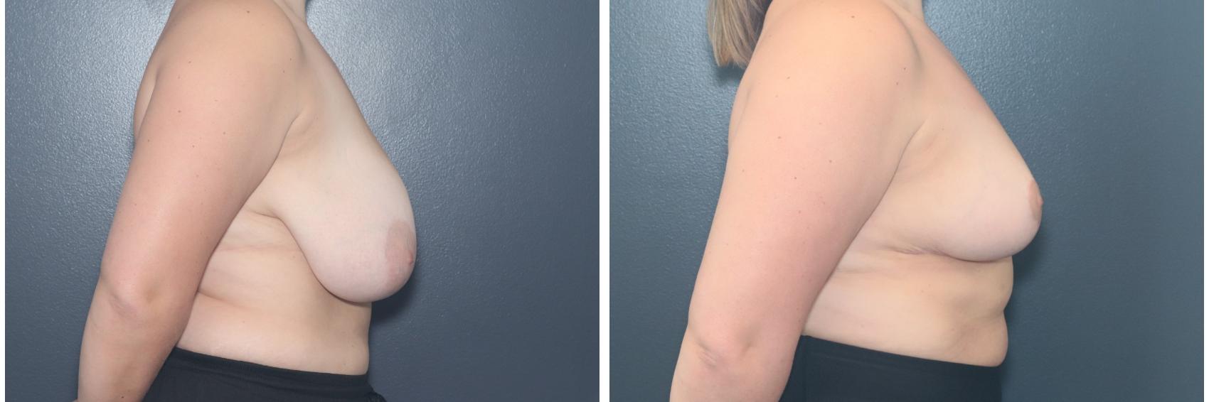 Before & After Breast Reduction Case 664 Left Side View in West Des Moines & Ames, IA