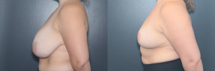Before & After Breast Reduction Case 664 Right Side View in West Des Moines & Ames, IA