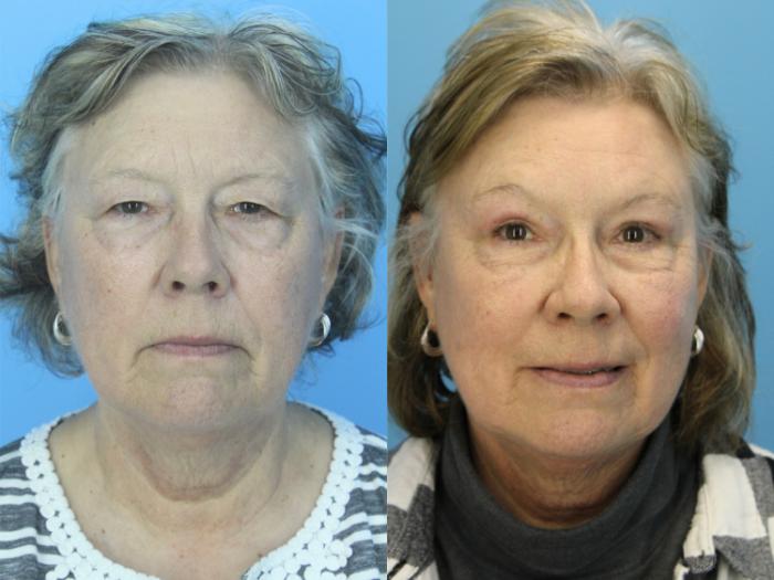 Before & After Blepharoplasty (Upper Eyelid Lift) Case 514 Front View in West Des Moines & Ames, IA