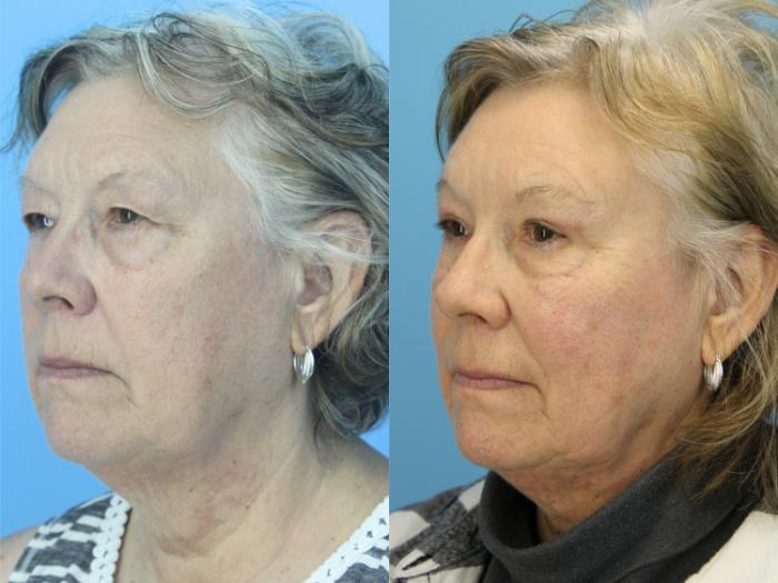 Before & After Brow Lift Case 514 Left Oblique View in West Des Moines & Ames, IA