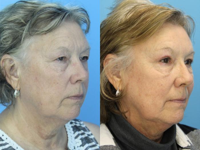 Before & After Brow Lift Case 514 Right Oblique View in West Des Moines & Ames, IA