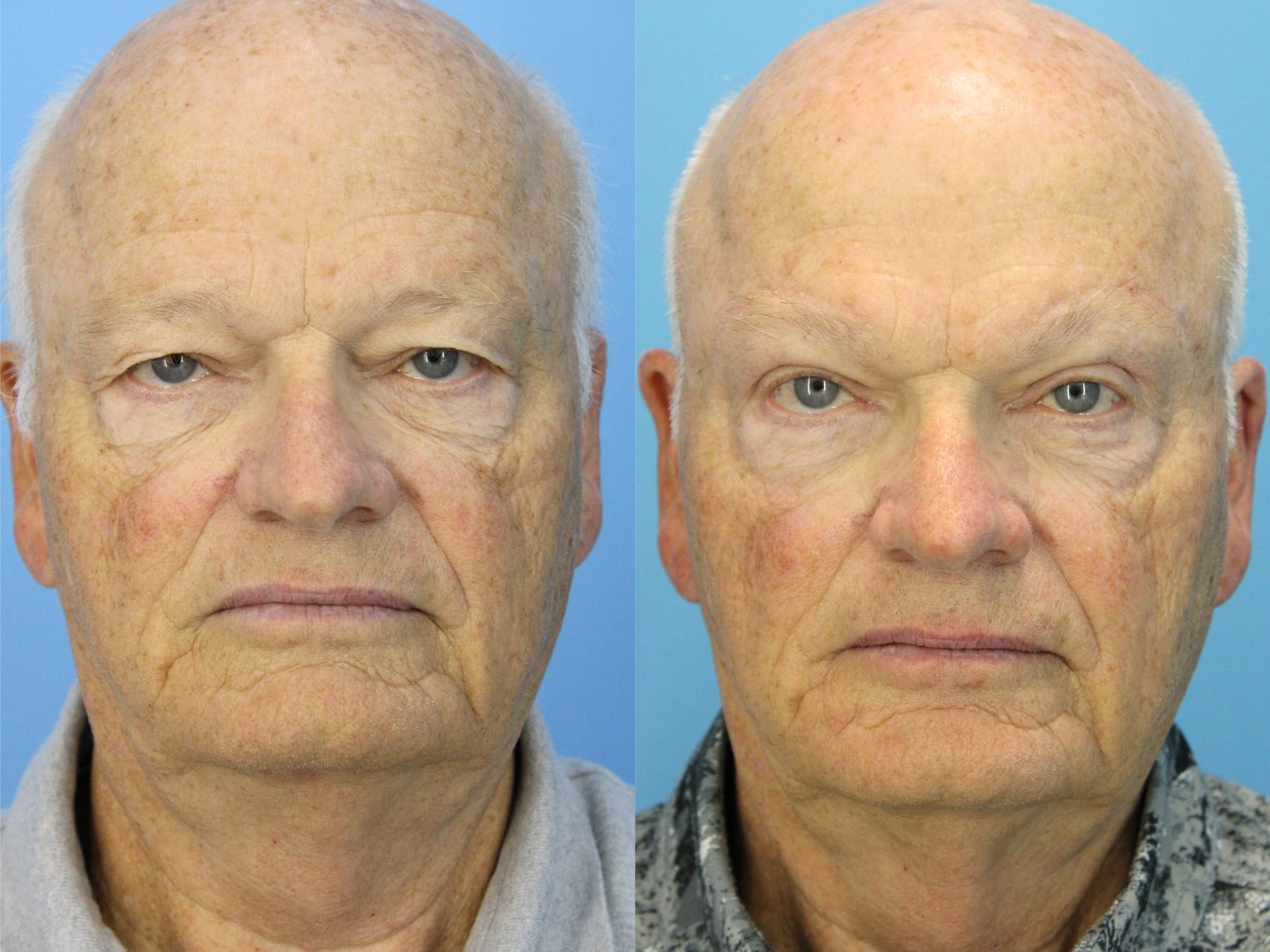 Before & After Eyelid Surgery (Upper Eyelid Lift) Case 569 Front View in West Des Moines & Ames, IA