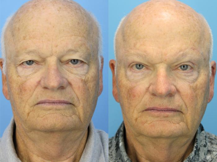 Before & After Eyelid Surgery (Upper Eyelid Lift) Case 569 Front View in West Des Moines & Ames, IA