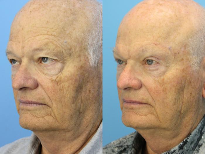 Before & After Eyelid Surgery (Upper Eyelid Lift) Case 569 Left Oblique View in West Des Moines & Ames, IA