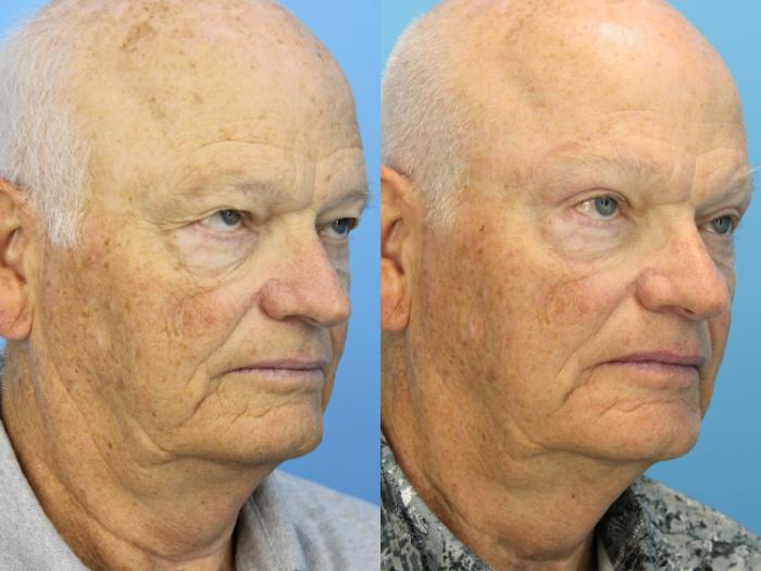 Before & After Eyelid Surgery (Upper Eyelid Lift) Case 569 Right Oblique View in West Des Moines & Ames, IA