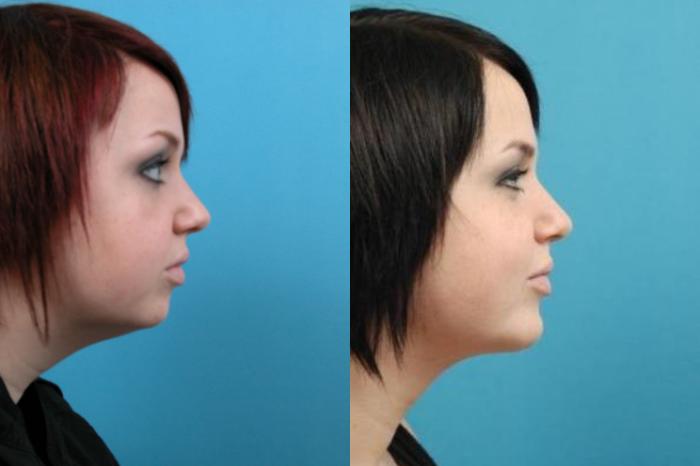 Before & After Chin Augmentation Case 14 View #1 View in West Des Moines & Ames, IA