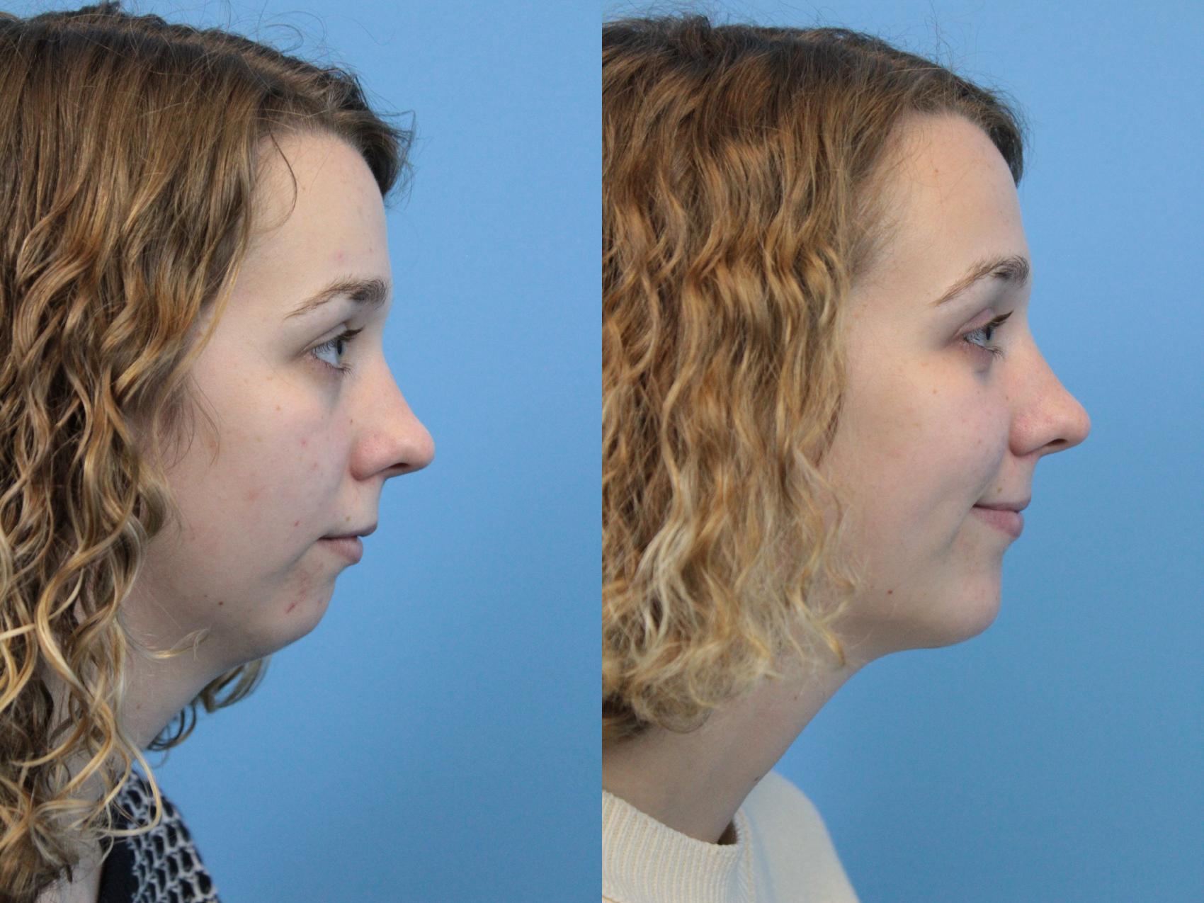 Before & After Chin Augmentation Case 184 View #1 View in West Des Moines, IA
