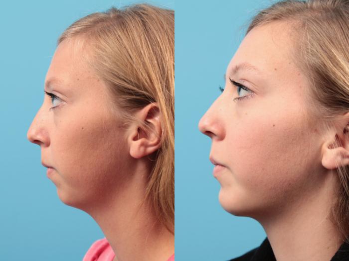 Before & After Chin Augmentation Case 27 View #1 View in West Des Moines & Ames, IA